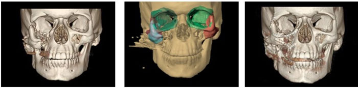 Craniofacial Surgery Boston