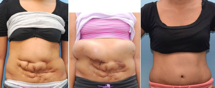 Tummy Tuck And Hernia Repair At The Same Time Rein mezquita